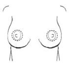 Breast uplift areolar scars