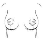 Breasts uplift anchor scarring