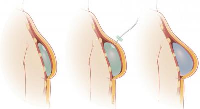 Expander Implant