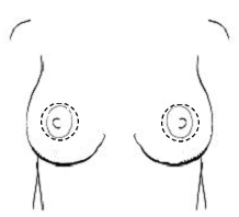 Breast uplift areolar scars