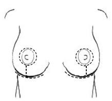 breast scarring