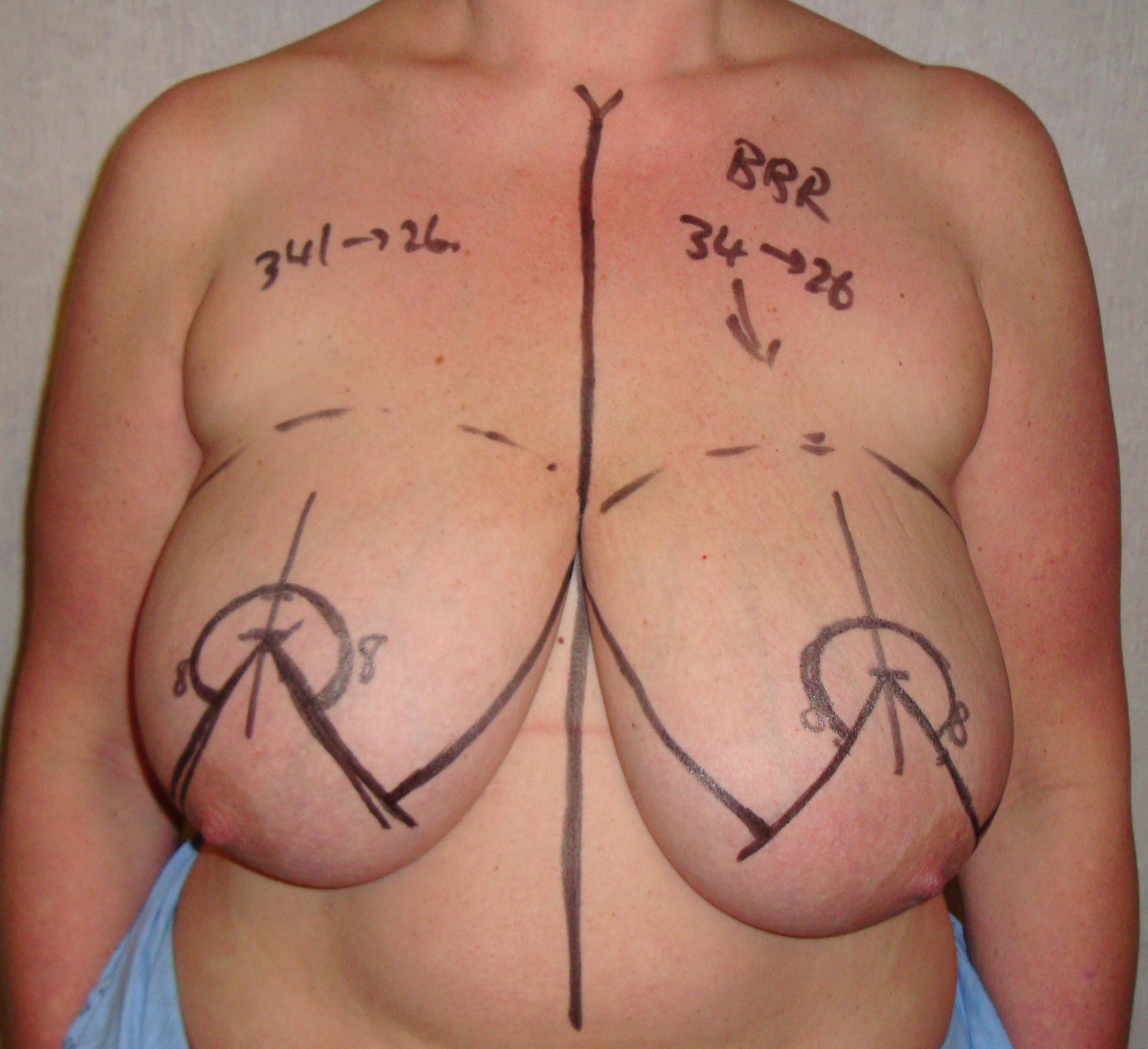 before breast reduction pictures